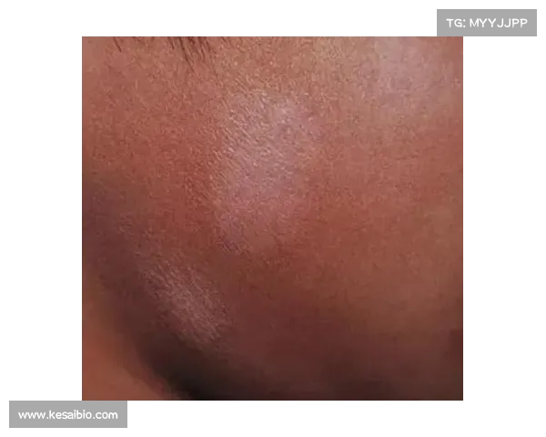 辐射对白斑伤害大揭秘